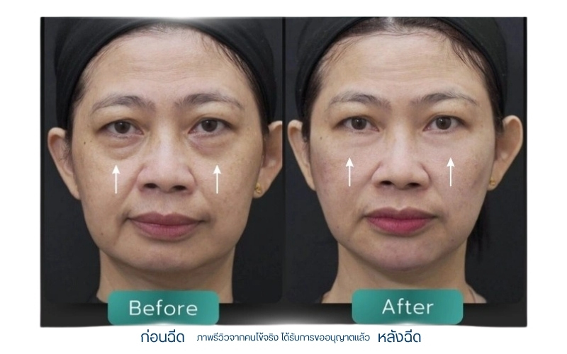 ความรู้สึกระหว่าง ฉีดฟิลเลอร์ใต้ตา เจ็บไหม?