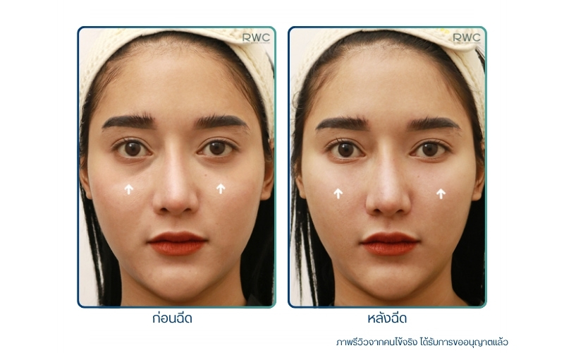 ฉีดฟิลเลอร์ใต้ตา รีวิว