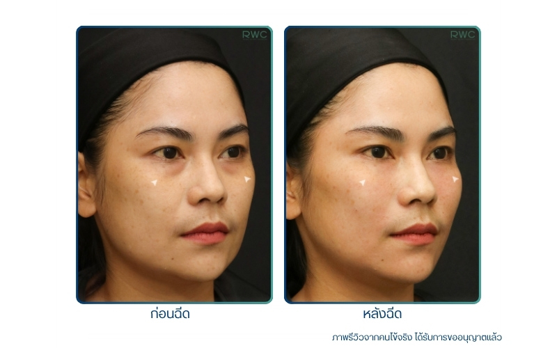 รีวิวฟิลเลอร์ใต้ตา