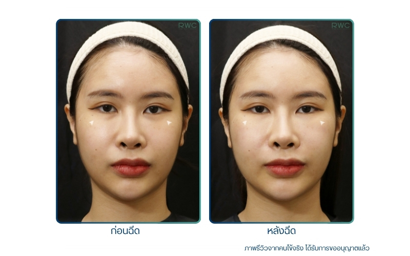 รีวิว ฉีดฟิลเลอร์ใต้ตา