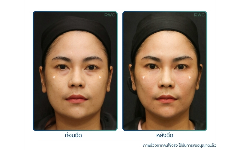ฟิลเลอร์ใต้ตา รีวิว