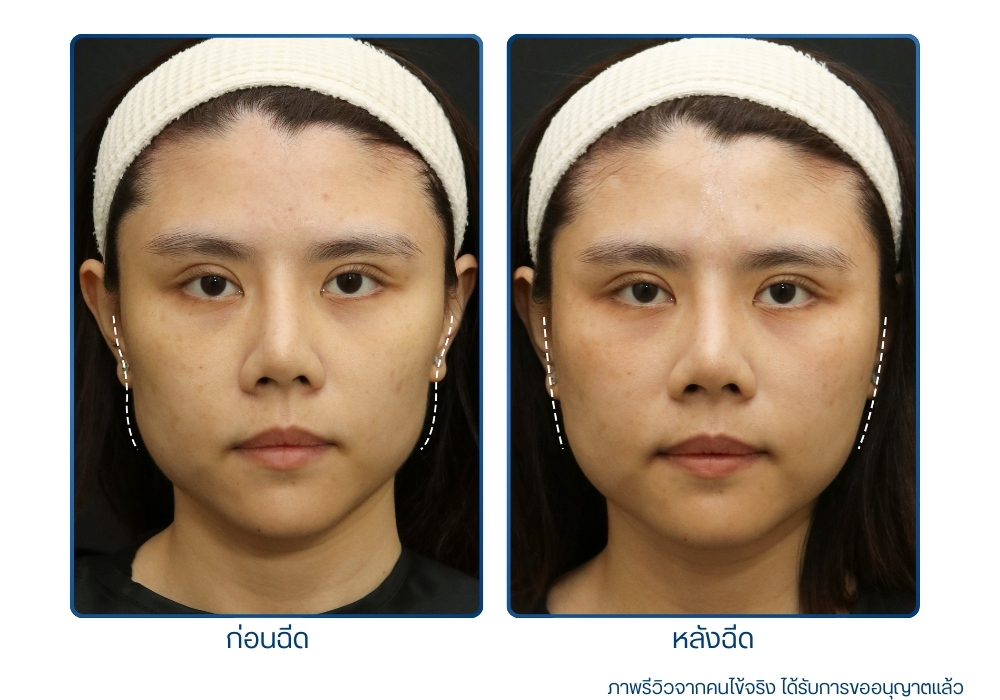 รีวิวก่อน-หลังทำ Botox Filler