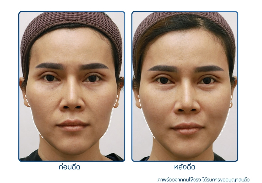 รีวิวก่อน-หลังทำ Botox Filler ที่ RWC Clinic