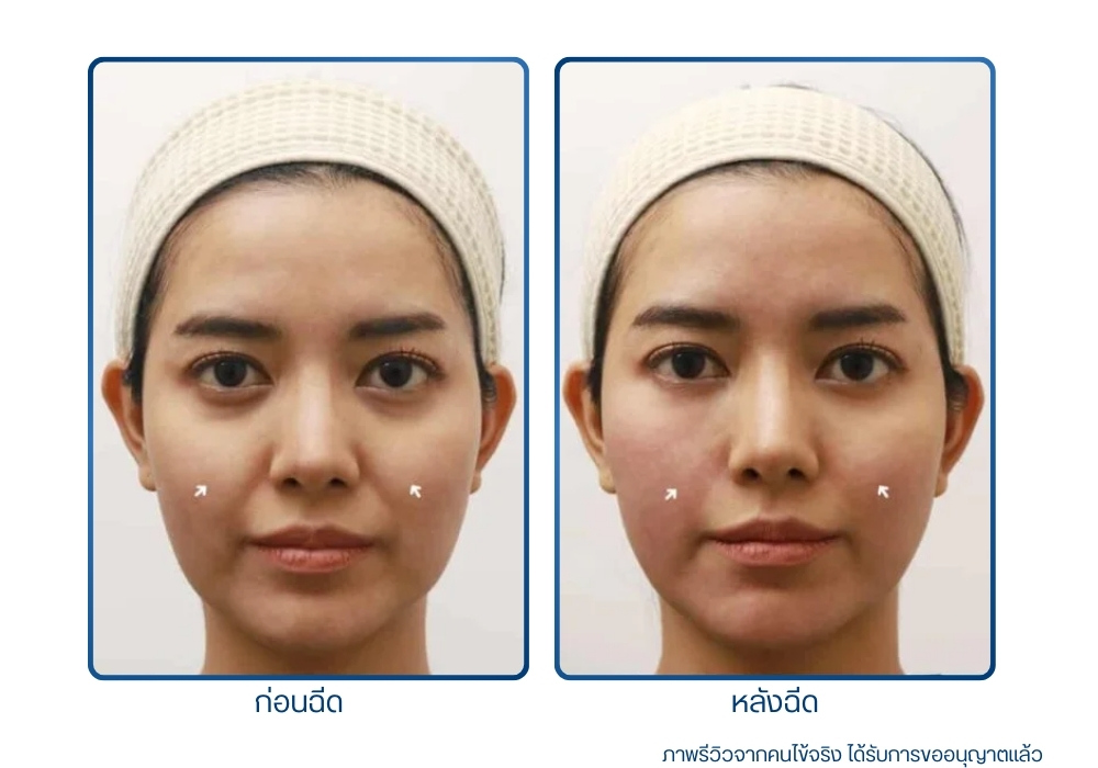 ก่อน-หลังทำ Botox Filler รีวิว