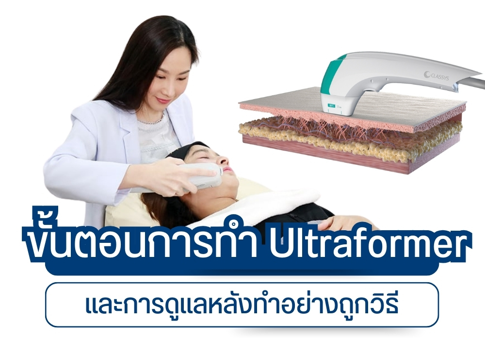 ขั้นตอนการทำ Ultraformer และการดูแลหลังทำอย่างถูกวิธี