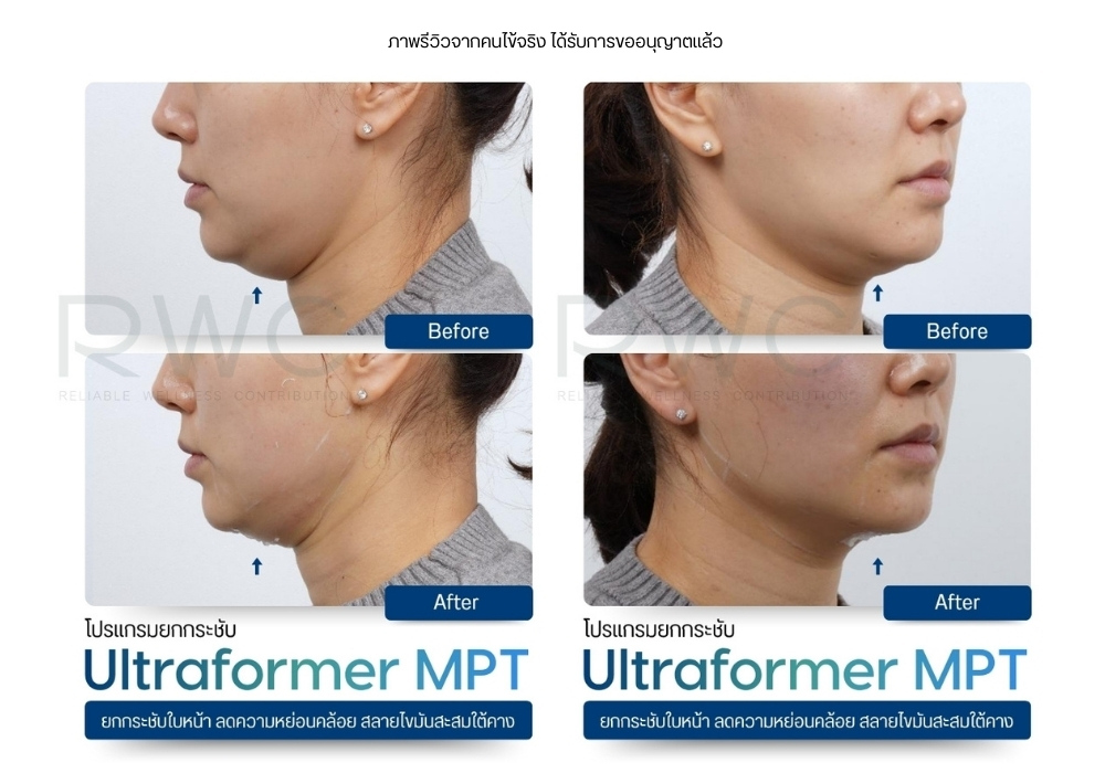 รีวิวจากผู้ใช้จริง Ultraformer