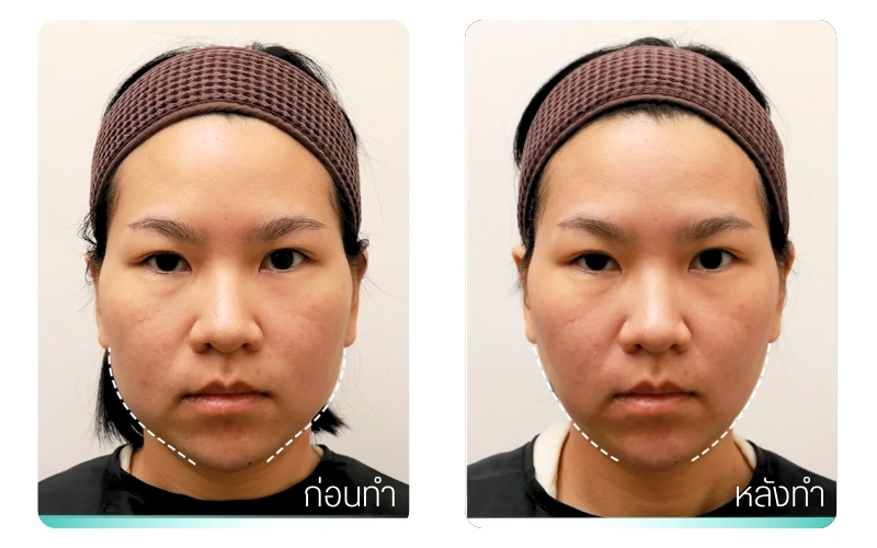 รีวิวก่อน-หลังร้อยไหมคอลลาเจน ที่ RWC Clinic