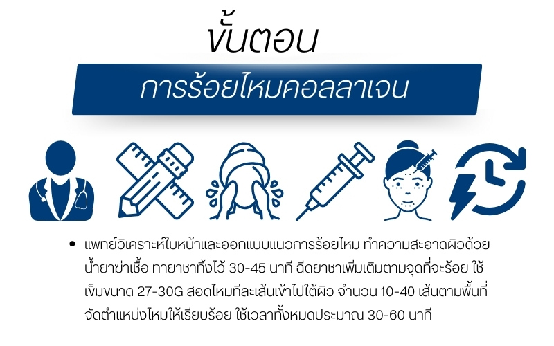 ขั้นตอนการร้อยไหมคอลลาเจน