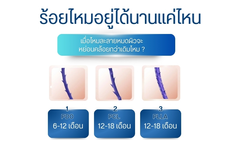 ร้อยไหมอยู่ได้นานแค่ไหน