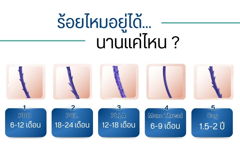 ร้อยไหมอยู่ได้นานแค่ไหน ?