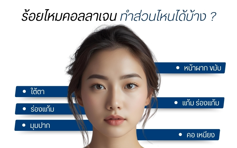 ร้อยไหมคอลลาเจนทำส่วนไหนได้บ้าง ?