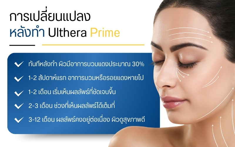 การเปลี่ยนแปลงหลังทำ Ulthera Prime