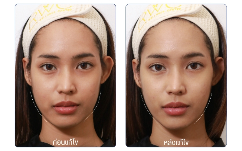 รีวิว Ulthera Prime RWC