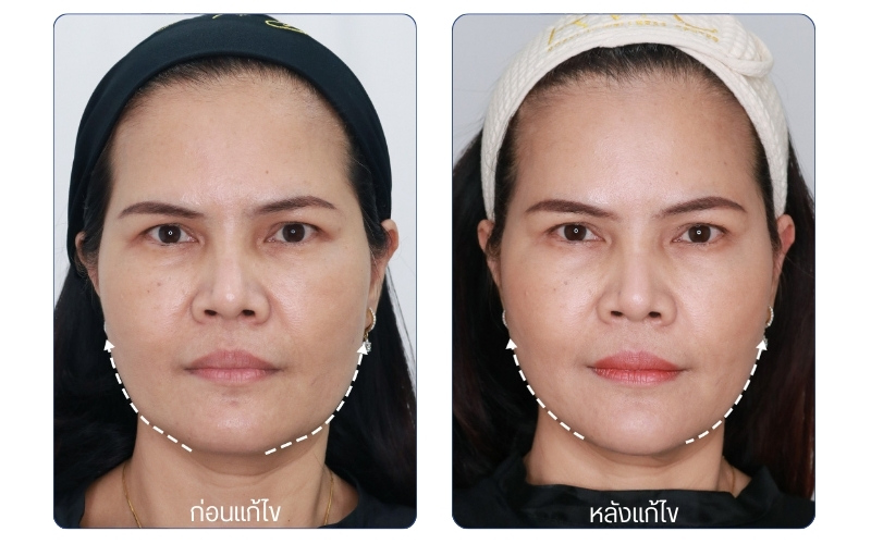 รีวิว Ulthera Prime