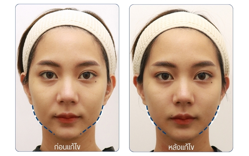 Ulthera Prime รีวิว