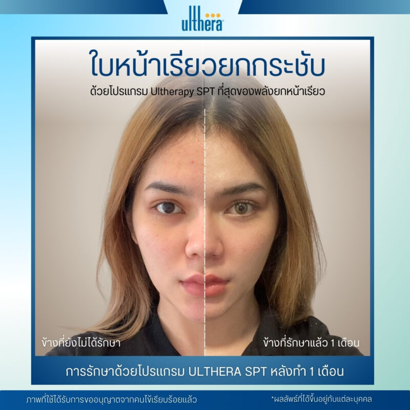 รีวิวการทำ Ulthera