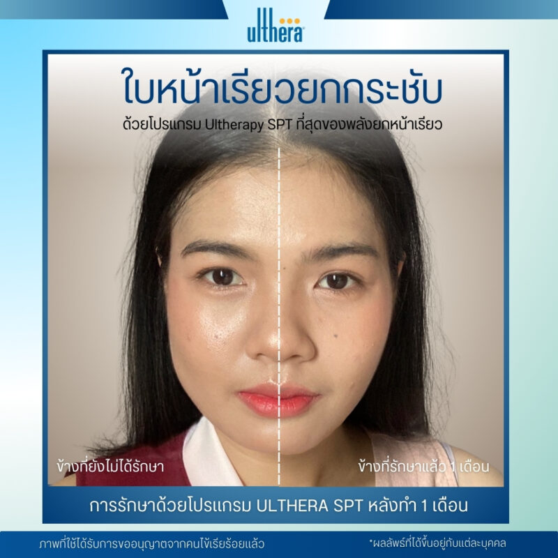 รีวิวการทำ Ulthera