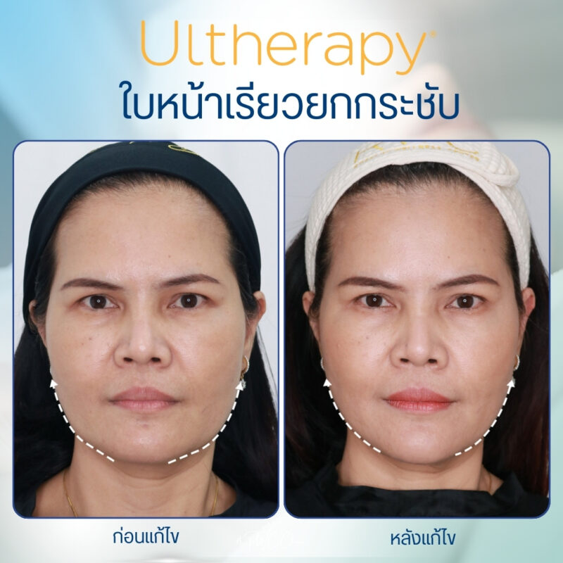 รีวิว Ulthera