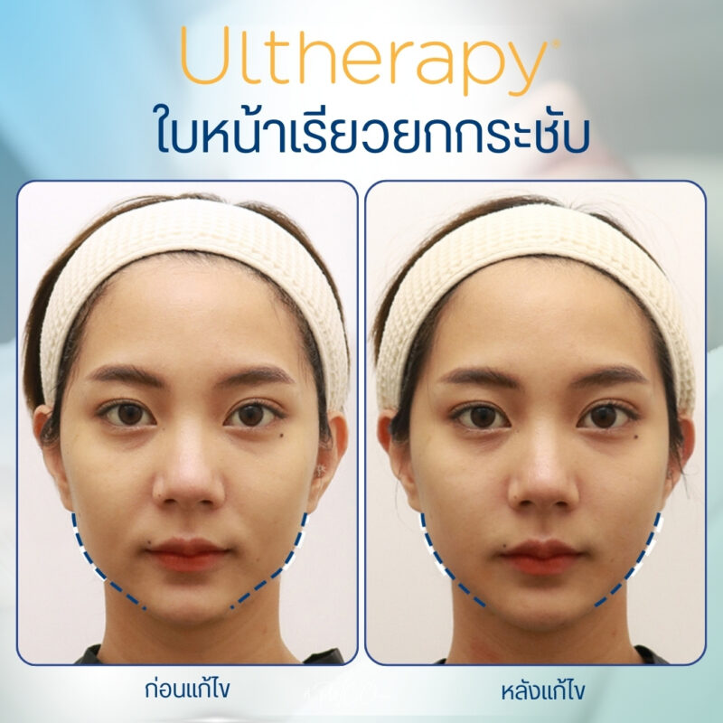 รีวิว Ulthera จากลูกค้า