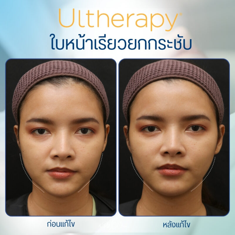 รีวิว Ulthera ของ RWC Clinic