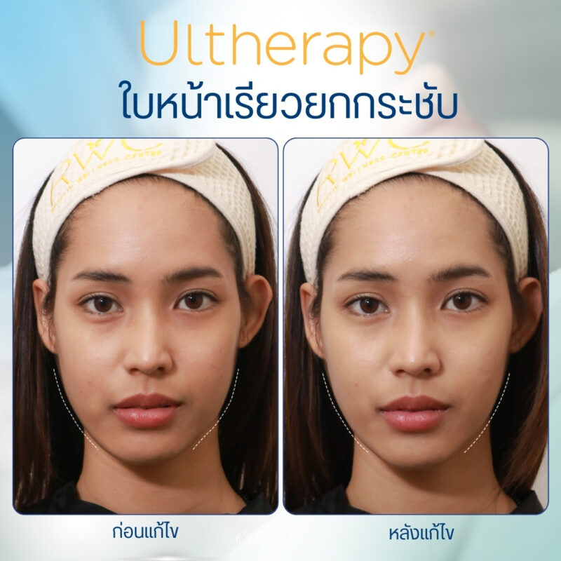 รีวิว Ulthera จากลูกค้าจริงของ RWC Clinic