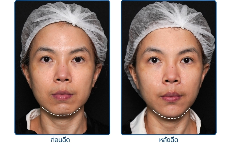รีวิวคางด้วยฟิลเลอร์