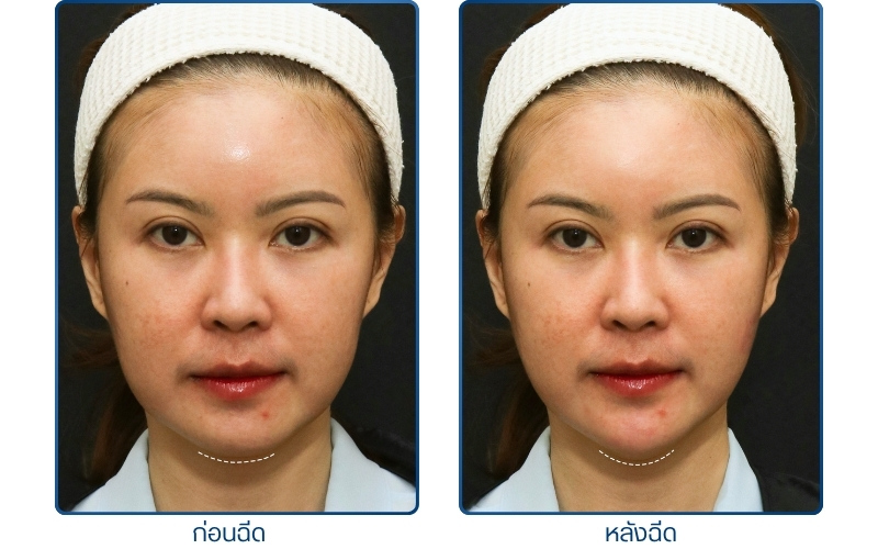 รีวิวฟิลเลอร์คาง