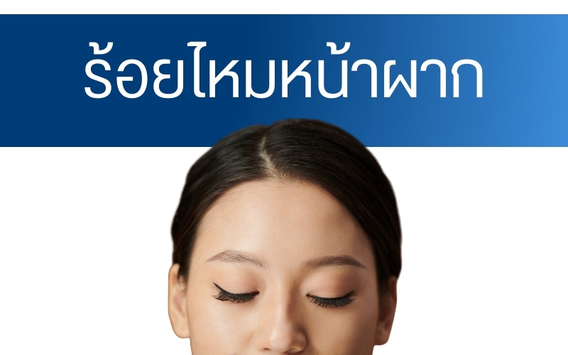 การร้อยไหมหน้าผาก คืออะไร?