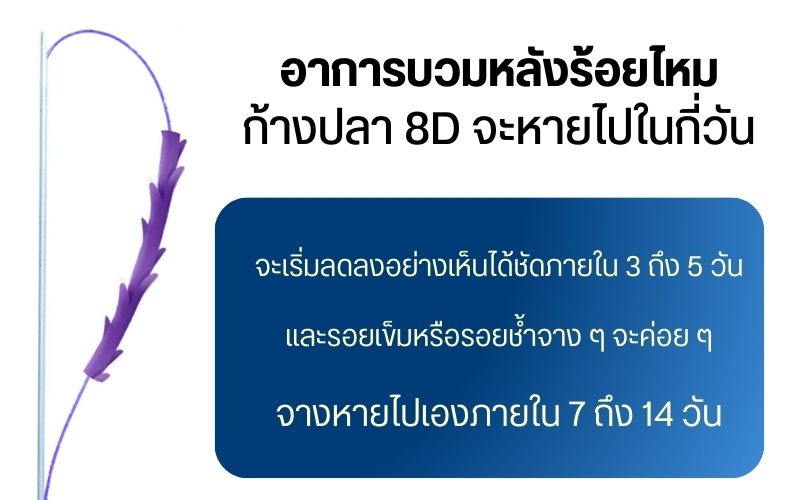 อาการบวมหลังร้อยไหม ก้างปลา 8d จะหายไปในกี่วัน