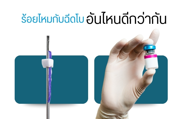 ร้อยไหมกับโบท็อกซ์อันไหนดีกว่ากัน ?