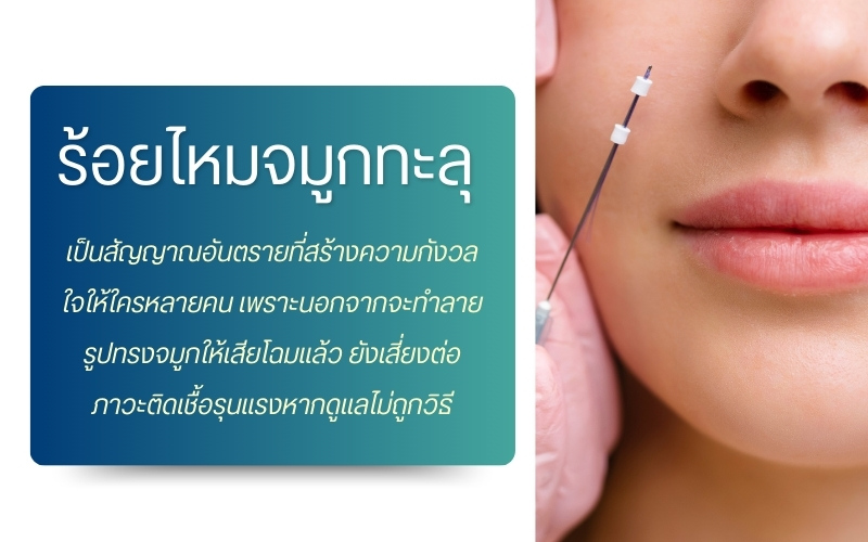 ร้อยไหมจมูก คืออะไร?