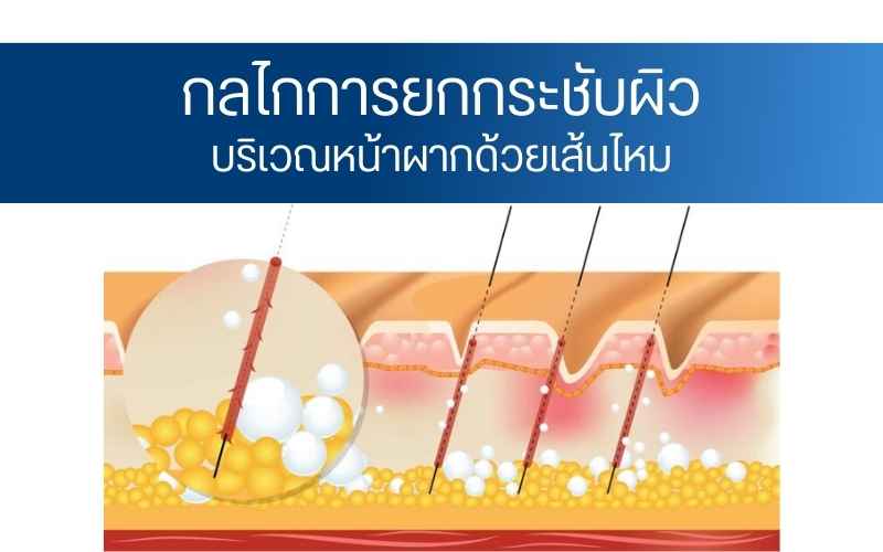 กลไกการยกกระชับผิวบริเวณหน้าผากด้วยเส้นไหม
