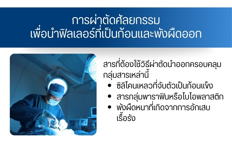 การผ่าตัดศัลยกรรมเพื่อนำฟิลเลอร์ที่เป็นก้อนและพังผืดออก