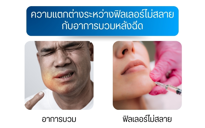 ความแตกต่างระหว่างฟิลเลอร์ไม่สลายกับอาการบวมหลังฉีด