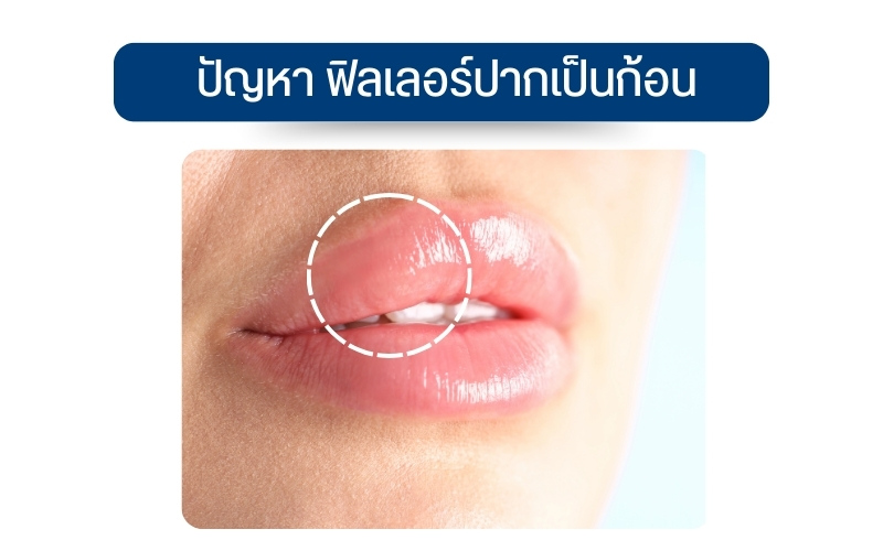 ปัญหา ฟิลเลอร์ปากเป็นก้อน