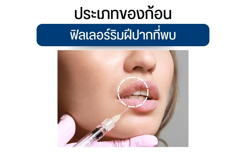 ประเภทของก้อนฟิลเลอร์ริมฝีปากที่พบ