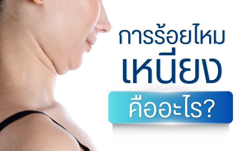 การร้อยไหมเหนียง คืออะไร?