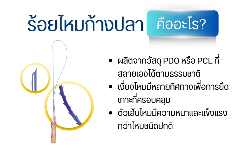 ร้อยไหมก้างปลา คืออะไร?