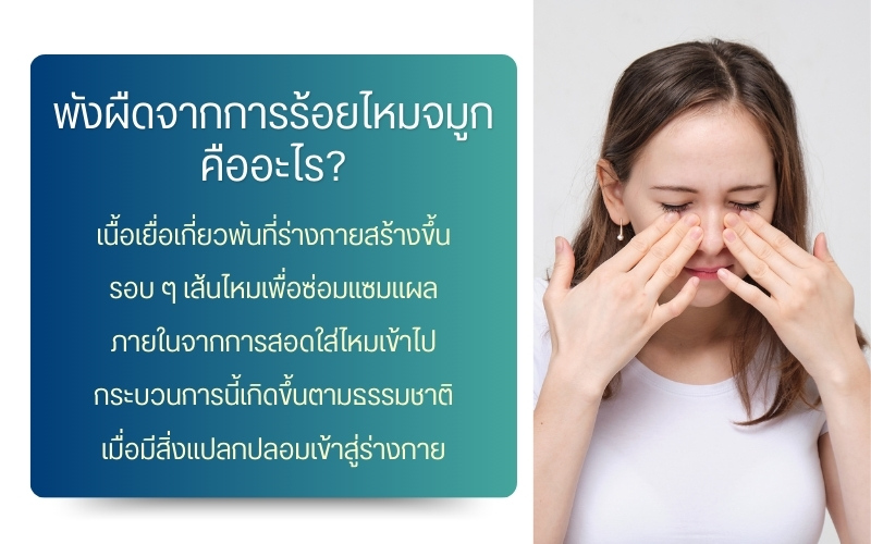พังผืดจากการร้อยไหมจมูก คืออะไร?
