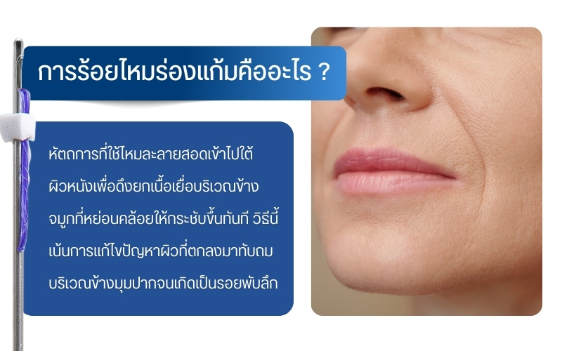 การร้อยไหมร่องแก้มคืออะไร ?