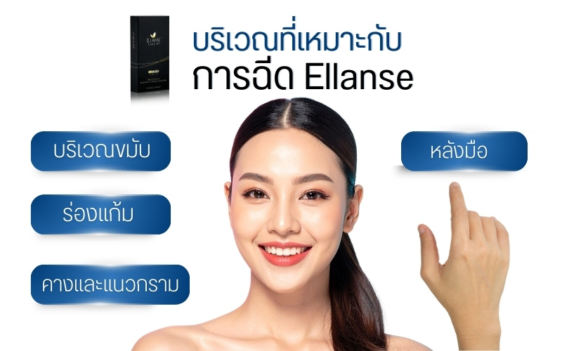 บริเวณที่เหมาะกับการฉีด Ellanse