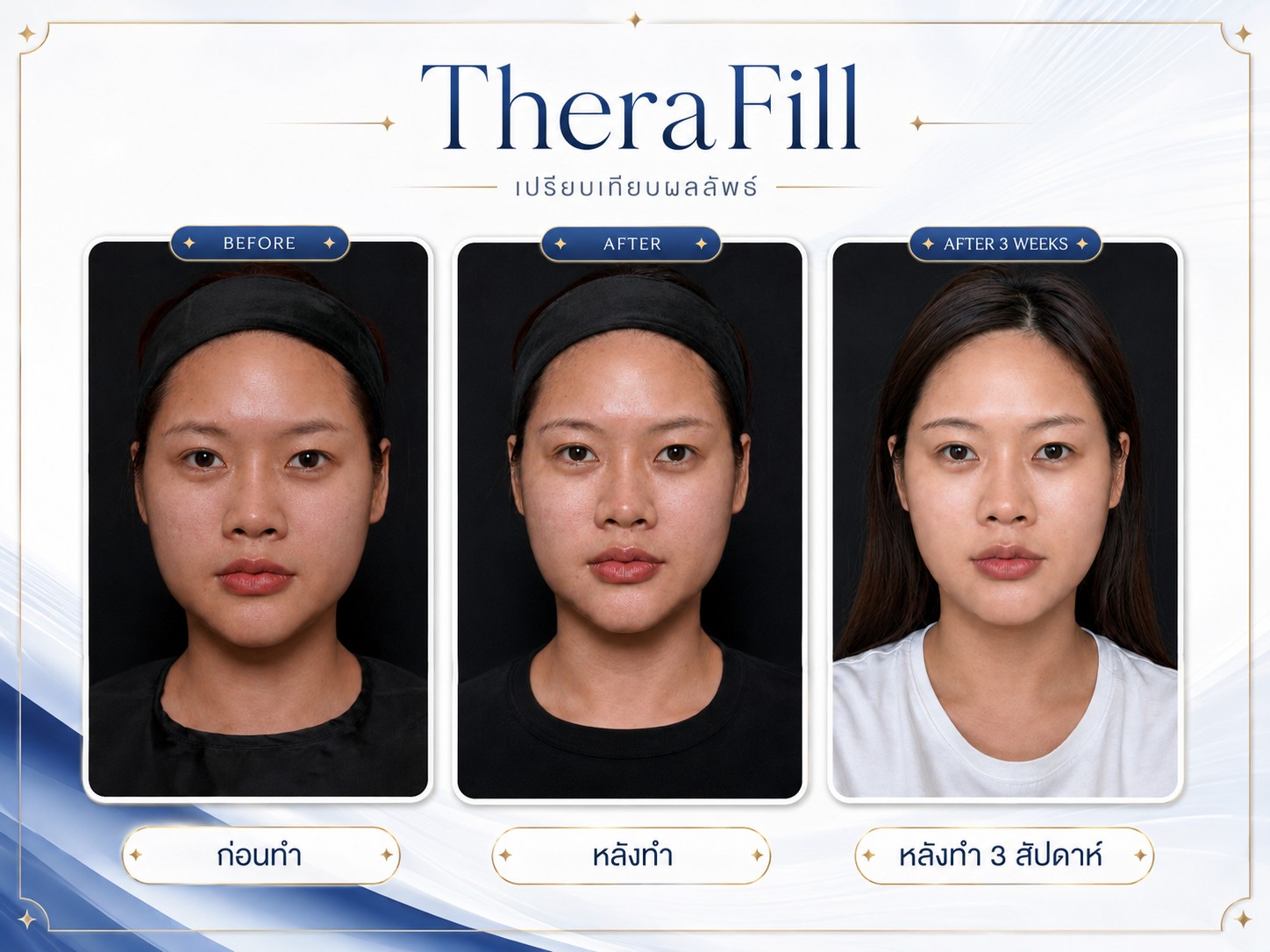 รีวิว Therafill