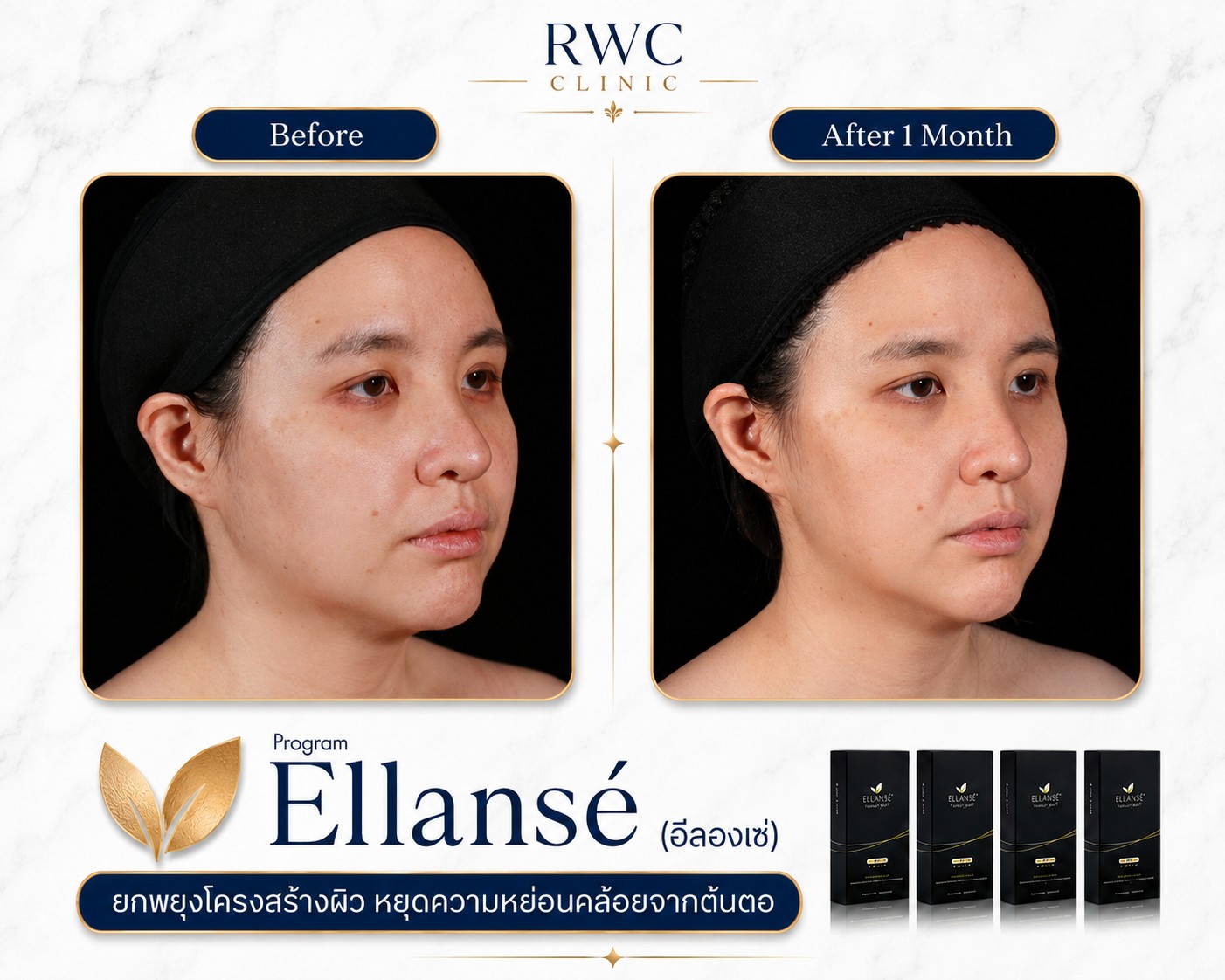 ภาพก่อนและหลังฉีด Ellanse ที่ 1 เดือน มุมเฉียง