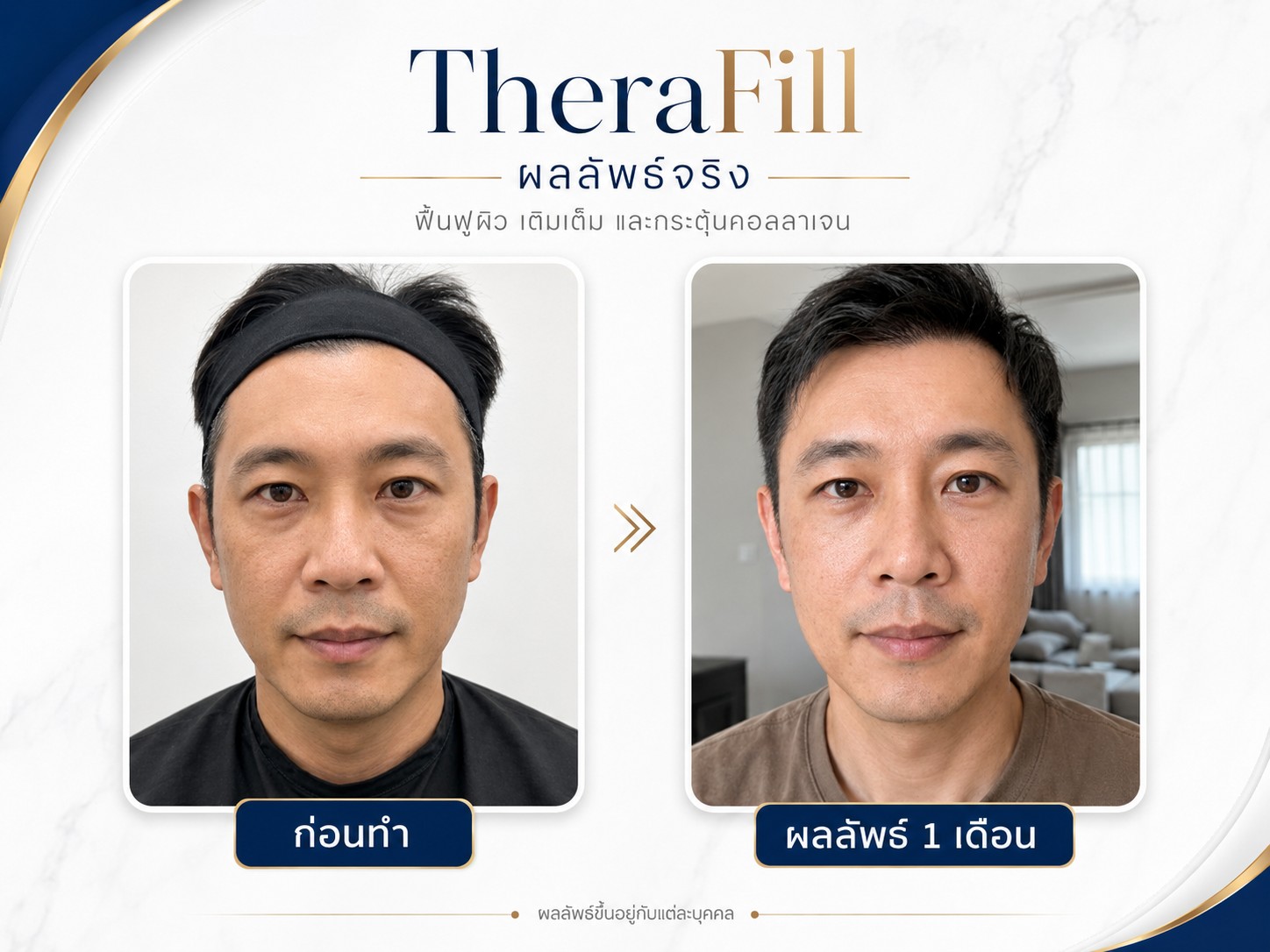 รีวิว Therafill rwc