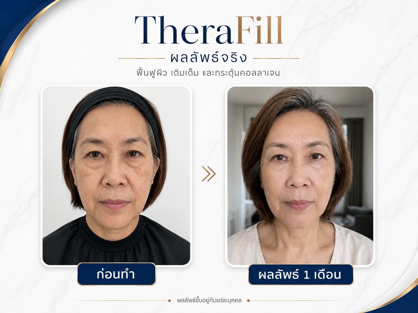 รีวิว Therafill ก่อน หลัง