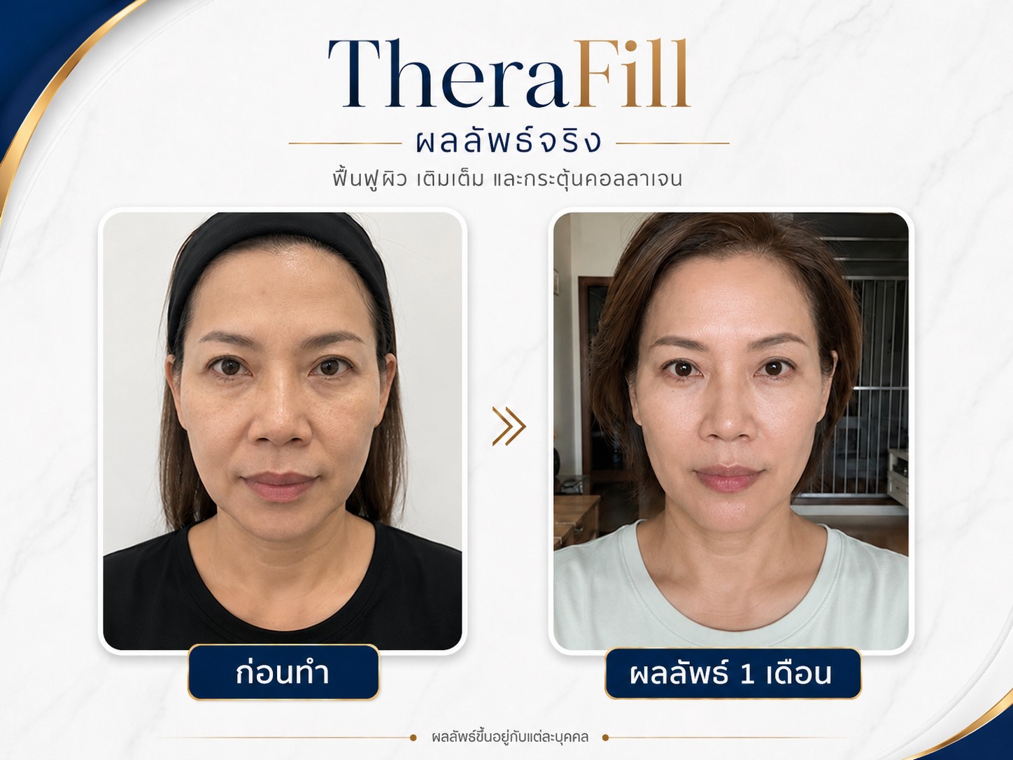 หลังทำ Therafill