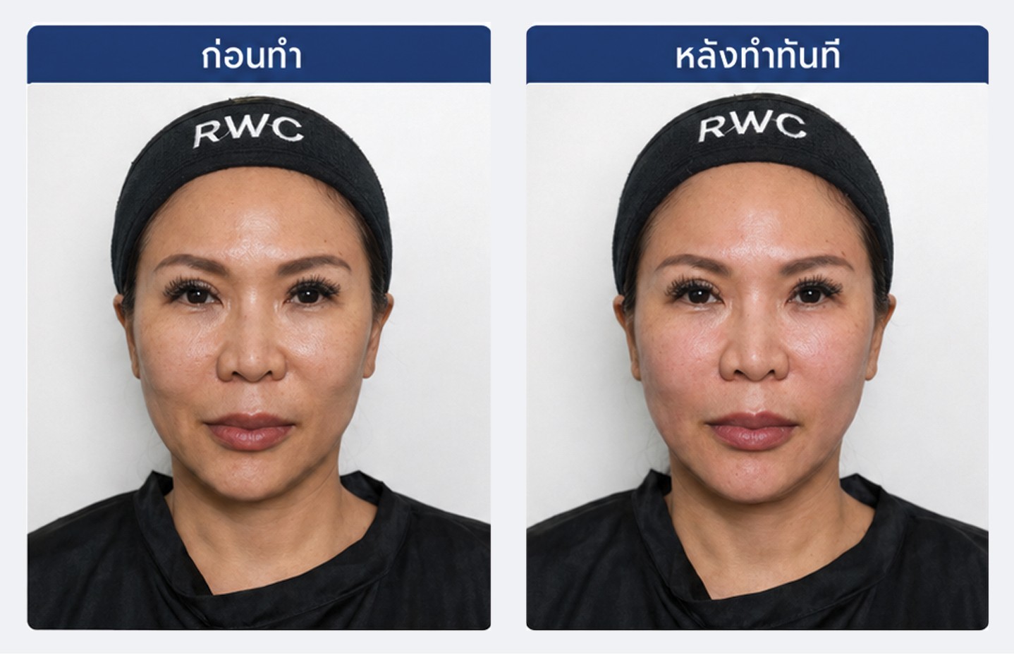 ภาพก่อนทำและหลังทำ Karisma ทันที มุมตรง