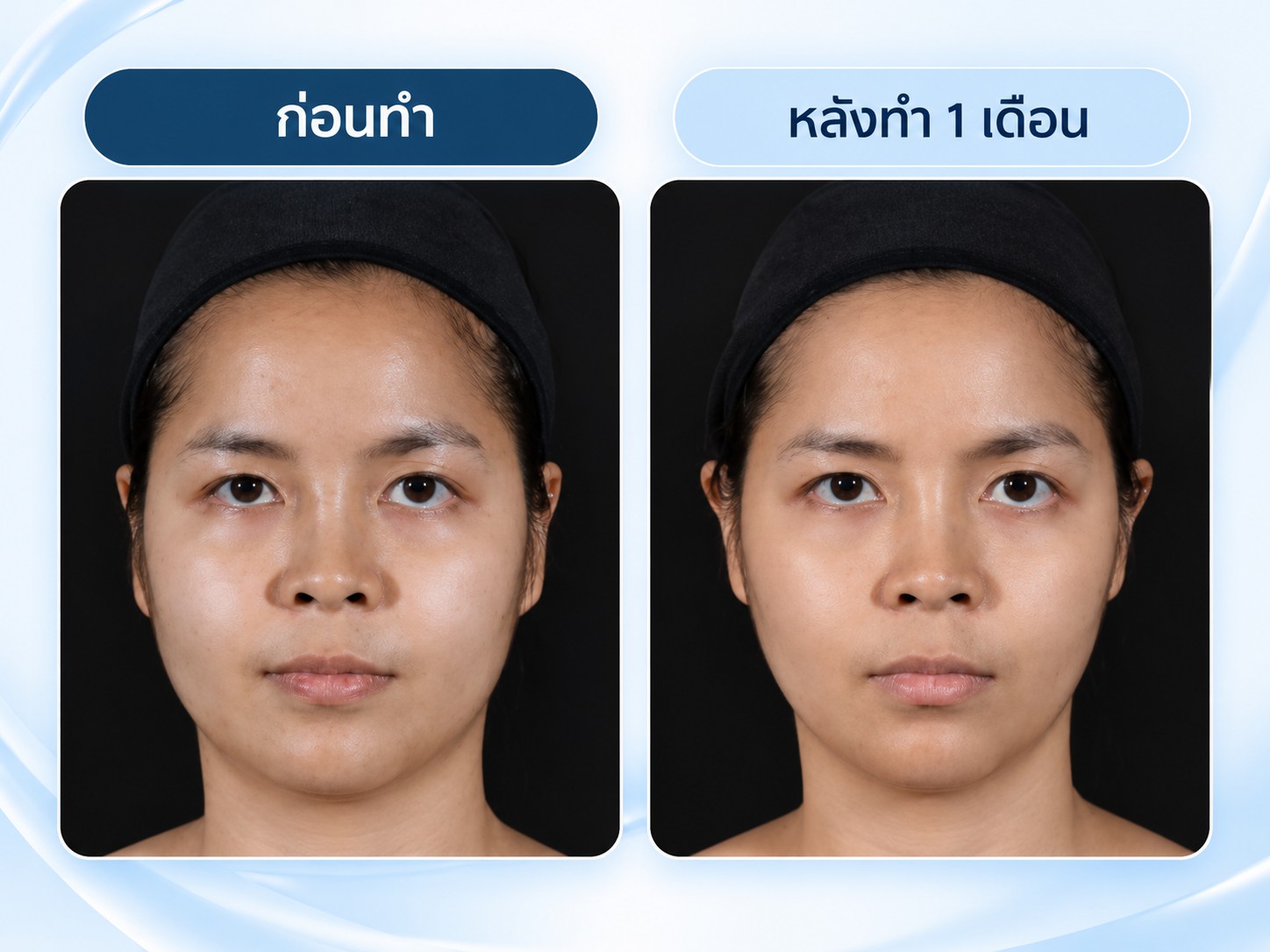 รีวิวฉีด ellanse
