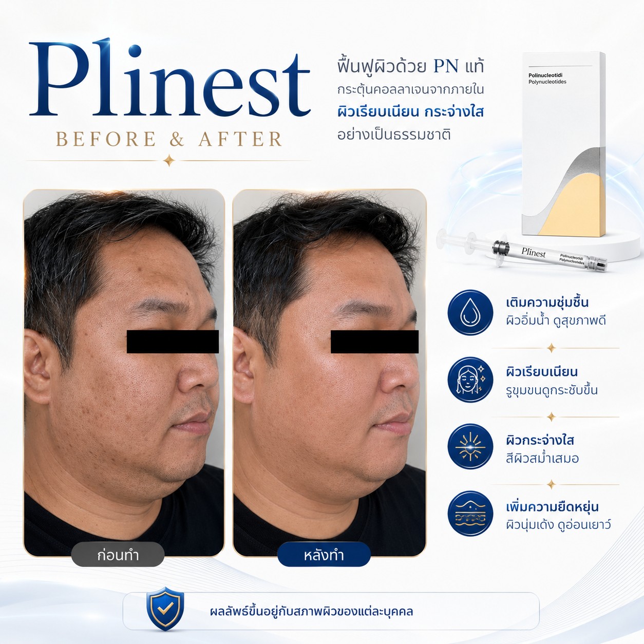 รีวิว Plinest