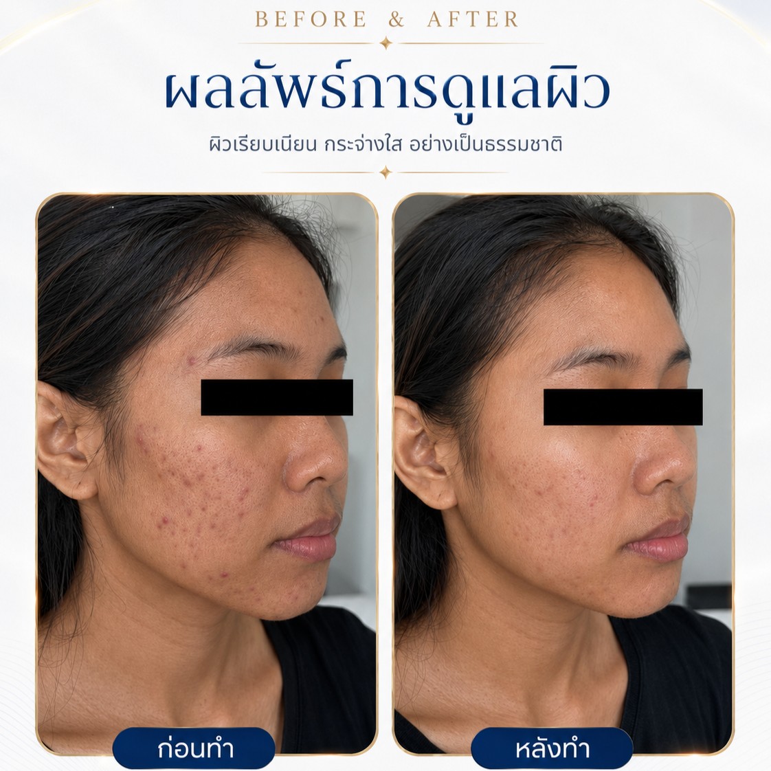 รีวิว Plinest Rwc clinic